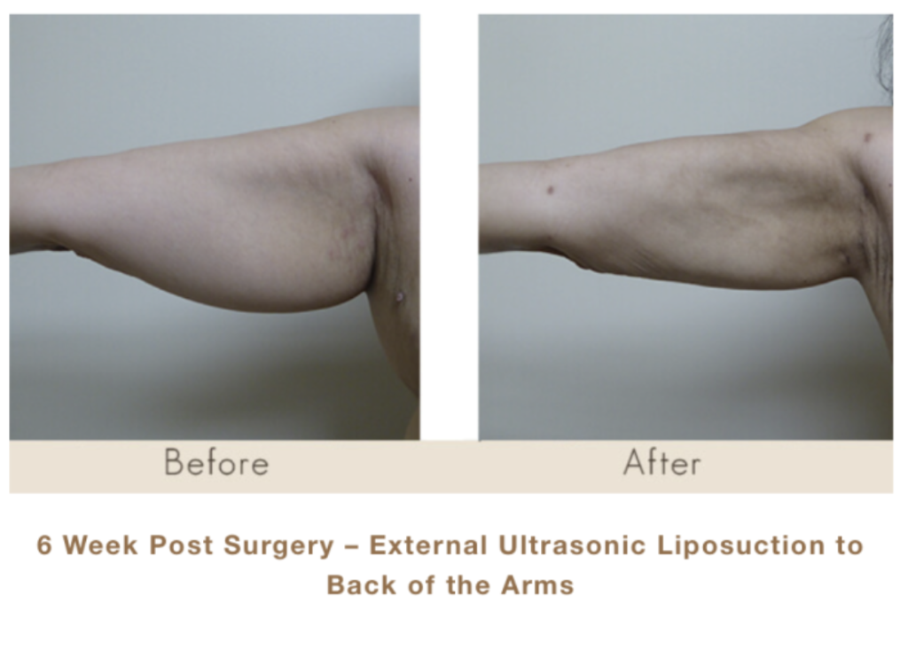 6 weeks post surgery - external ultrasonic liposuction to back of the arms.